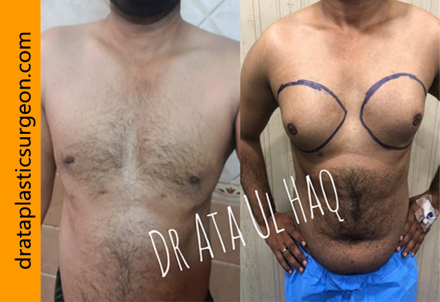 gynecomastia-in-lahore-22