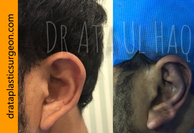 otoplasty-in-lahore2