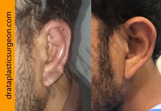 otoplasty-in-lahore4