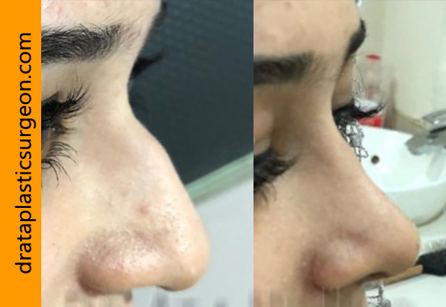rhinoplasty-in-lahore12