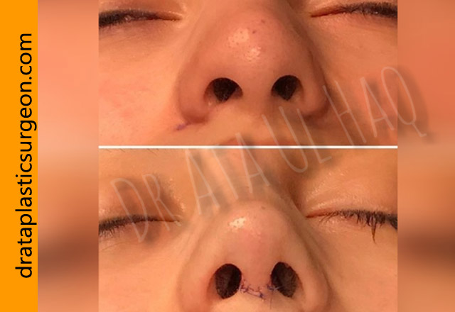 rhinoplasty-in-lahore3